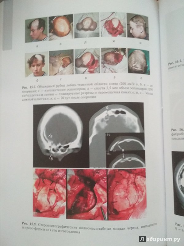 Иллюстрация 10 из 32 для Черепно-мозговая травма. Диагностика и лечение - Леонид Лихтерман | Лабиринт - книги. Источник: Кsena