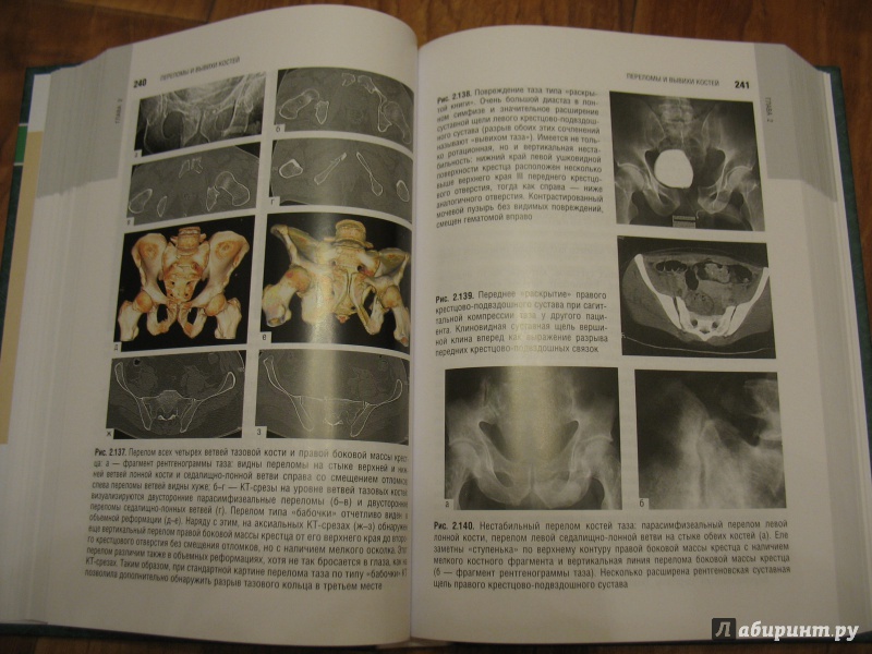 Иллюстрация 5 из 11 для Лучевая диагностика заболеваний костей и суставов. Национальное руководство | Лабиринт - книги. Источник: Крелена