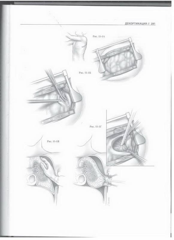 Иллюстрация 16 из 30 для Атлас торакальной хирургии - Марк Фергюсон | Лабиринт - книги. Источник: Ялина