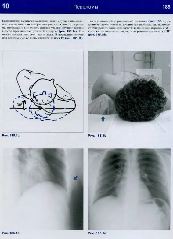 Иллюстрация 29 из 32 для Рентгенологическое исследование грудной клетки. Практическое руководство - Матиас Хофер | Лабиринт - книги. Источник: Алонсо Кихано