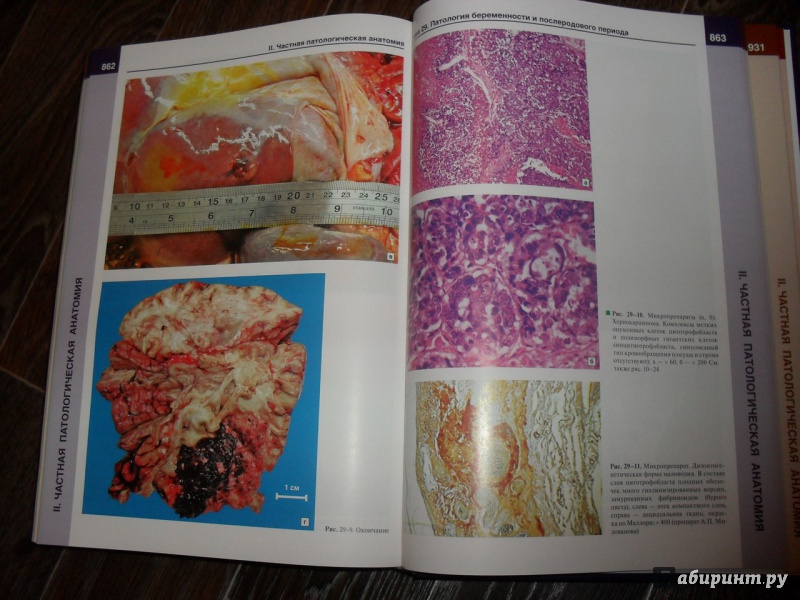 Иллюстрация 18 из 34 для Патологическая анатомия. Атлас. Учебное пособие - Зайратьянц, Бойкова, Зотова | Лабиринт - книги. Источник: ВраЧиталла