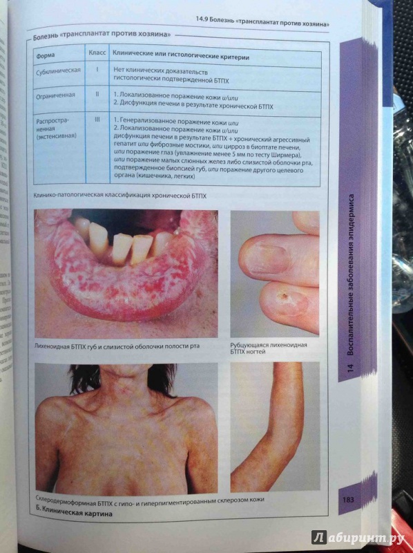 Иллюстрация 9 из 14 для Атлас по дерматологии - Бургдорф, Рекен, Шаллер, Заттлер | Лабиринт - книги. Источник: ВраЧиталла