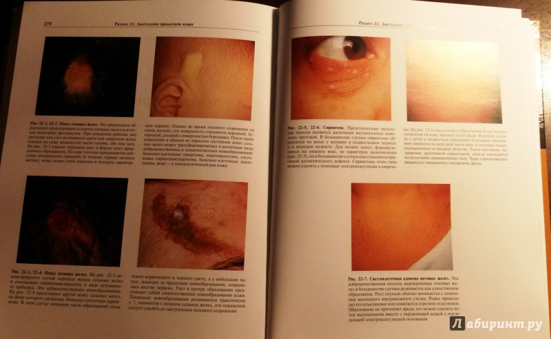 Иллюстрация 6 из 18 для Детская дерматология. Атлас - Вейнберг, Проуз, Кристал | Лабиринт - книги. Источник: Буторина  Елена