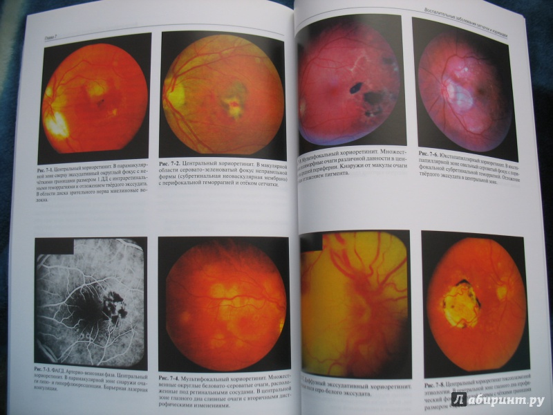 Иллюстрация 7 из 10 для Клинический атлас патологии глазного дна - Кацнельсон, Лысенко, Балишанская | Лабиринт - книги. Источник: Крелена