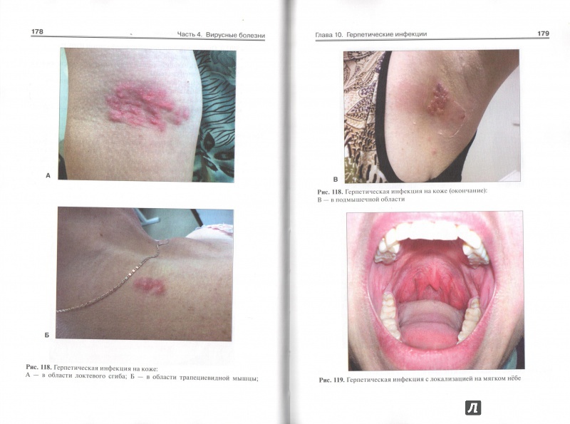 Иллюстрация 6 из 9 для Атлас инфекционных болезней - Лучшев, Жаров, Никифоров | Лабиринт - книги. Источник: ВраЧиталла