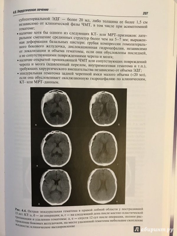 Иллюстрация 22 из 32 для Черепно-мозговая травма. Диагностика и лечение - Леонид Лихтерман | Лабиринт - книги. Источник: Ромыдтчъ
