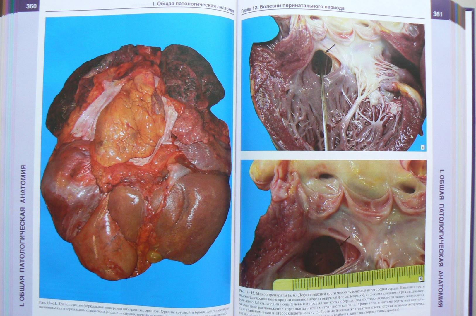 Иллюстрация 33 из 34 для Патологическая анатомия. Атлас. Учебное пособие - Зайратьянц, Бойкова, Зотова | Лабиринт - книги. Источник: Лидия