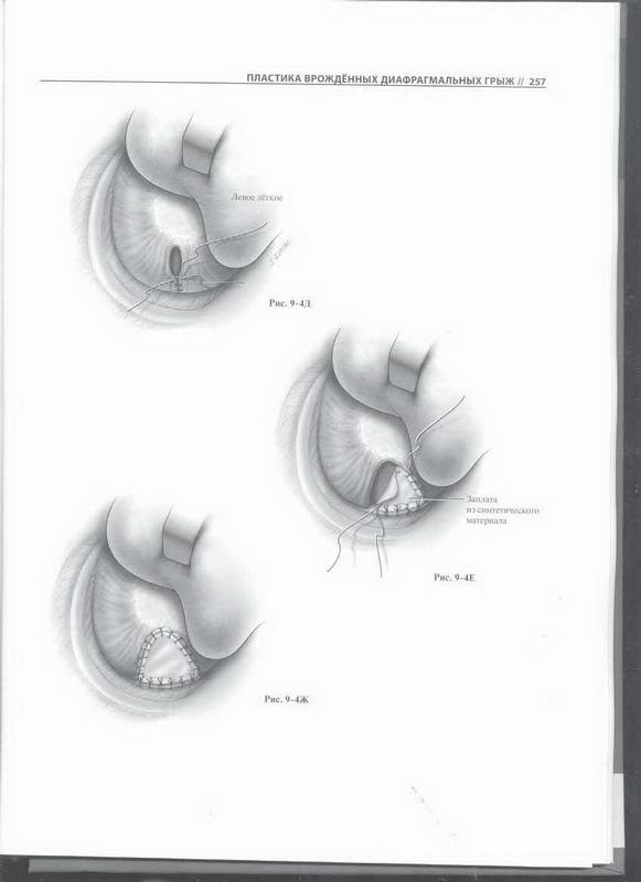 Иллюстрация 14 из 30 для Атлас торакальной хирургии - Марк Фергюсон | Лабиринт - книги. Источник: Ялина