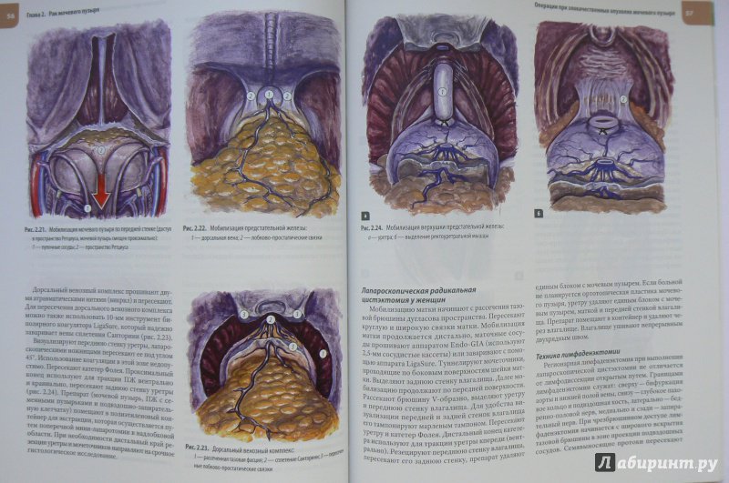 Иллюстрация 4 из 6 для Атлас операций при злокачественных опухолях органов мочеполовой системы - Каприн, Русаков, Алексеев | Лабиринт - книги. Источник: Марина
