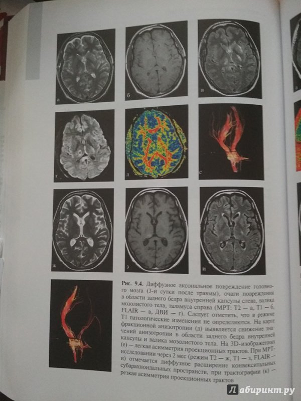 Иллюстрация 9 из 32 для Черепно-мозговая травма. Диагностика и лечение - Леонид Лихтерман | Лабиринт - книги. Источник: Кsena