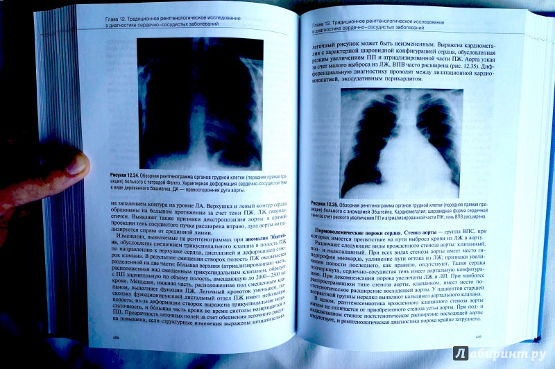 Иллюстрация 9 из 29 для Руководство по кардиологии. Том 2. Методы диагностики сердечно-сосудистых заболеваний | Лабиринт - книги. Источник: sakedas