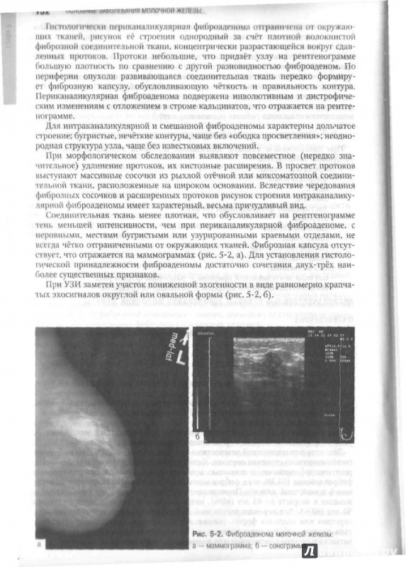 Фиброаденомы форум отзывы. Периканаликулярная фиброаденома. Периканаликулярная фиброаденома молочной железы. Периканаликулярная фиброаденома молочной железы гистология. Периканаликулярная фиброаденома молочной железы УЗИ.