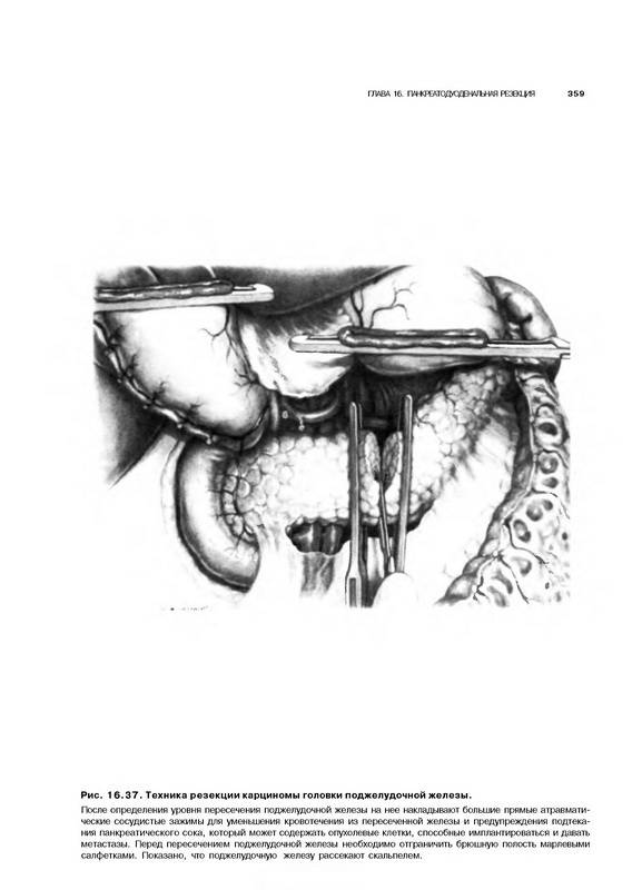 Иллюстрация 27 из 44 для Атлас абдоминальной хирургии. Том 1. Хирургия печени, желчных путей, поджелудочной железы - Эмилио Итала | Лабиринт - книги. Источник: Риззи