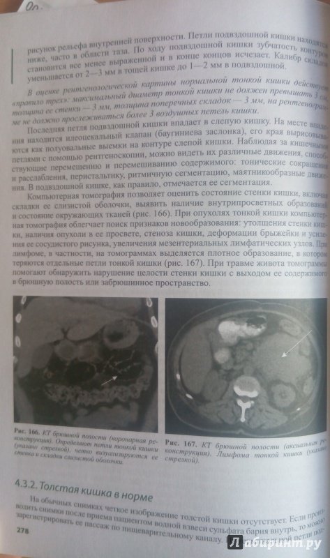 Иллюстрация 11 из 53 для Лучевая диагностика. Учебник - Королюк, Линденбратен | Лабиринт - книги. Источник: Kapzen