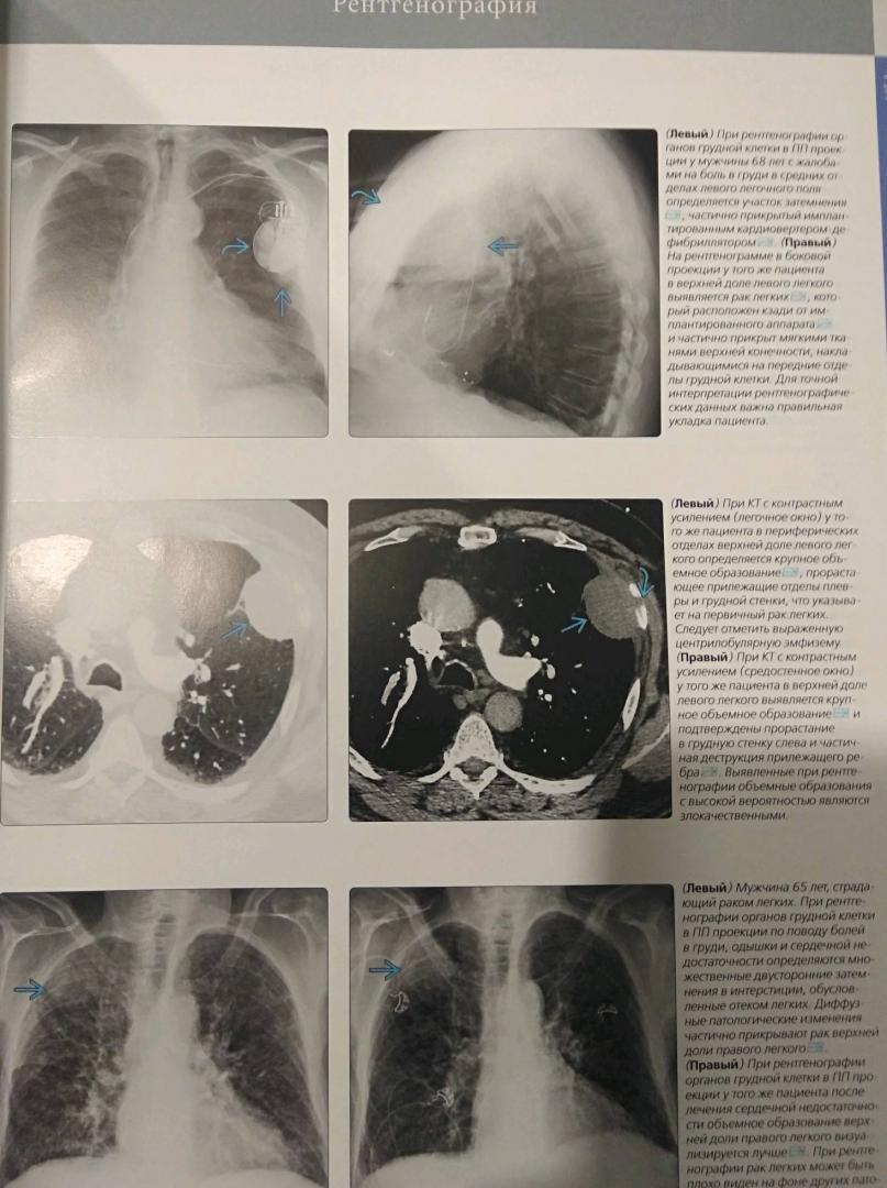 Иллюстрация 12 из 12 для Лучевая диагностика. Опухоли органов грудной клетки - Розадо-де-Кристенсон, Картер | Лабиринт - книги. Источник: Савчук Ирина
