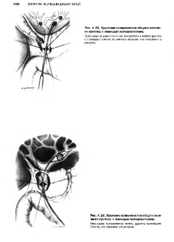 Иллюстрация 37 из 44 для Атлас абдоминальной хирургии. Том 1. Хирургия печени, желчных путей, поджелудочной железы - Эмилио Итала | Лабиринт - книги. Источник: Федосов  Прохор Сергеевич