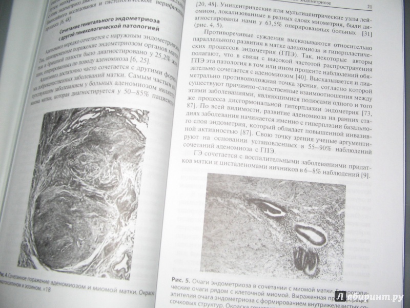 Иллюстрация 5 из 12 для Генитальный эндометриоз: взгляд практикующего врача. Монография - Дамиров, Олейникова, Майорова | Лабиринт - книги. Источник: Alonka