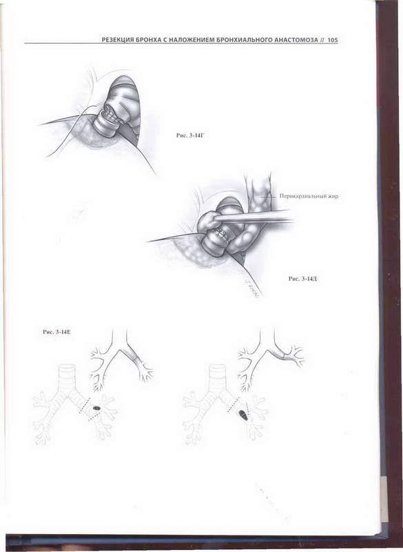 Иллюстрация 13 из 30 для Атлас торакальной хирургии - Марк Фергюсон | Лабиринт - книги. Источник: Ялина
