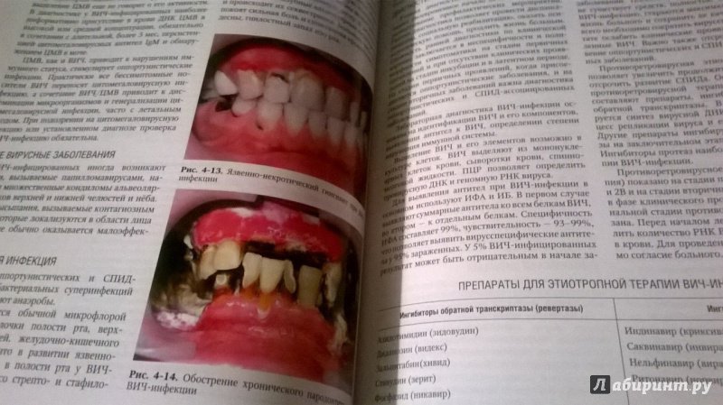 Иллюстрация 7 из 28 для Терапевтическая стоматология. Заболевания слизистой оболочки рта. В 3-х частях. Часть 3. Учебник - Барер, Волков, Гемонов | Лабиринт - книги. Источник: Natalya4099