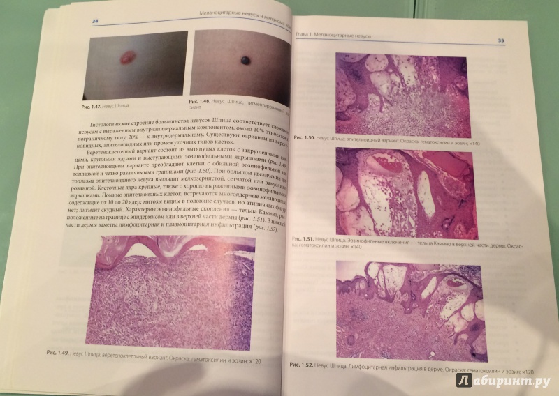 Иллюстрация 2 из 4 для Меланоцитарные невусы и меланома кожи. Руководство для практикующих врачей - Молочков, Демидов, Харкевич | Лабиринт - книги. Источник: Жигулина  Анютка