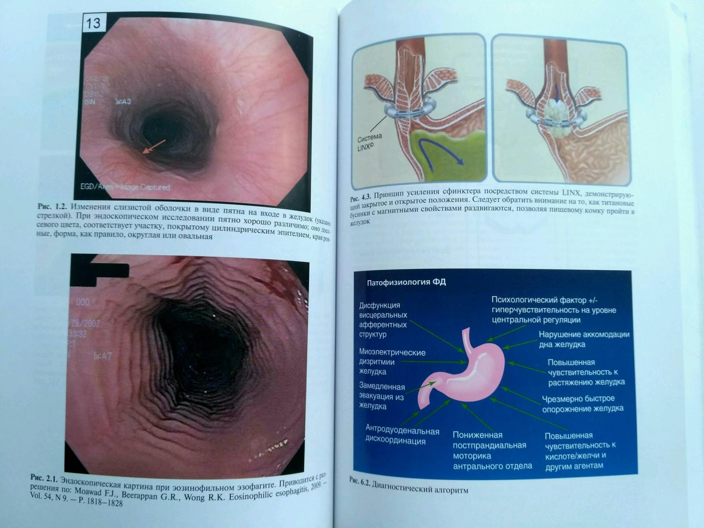 Иллюстрация 27 из 31 для Функциональные расстройства желудочно-кишечного тракта. Практический подход на основе клинического - Лэйси, Кроуэлл, ДиБайз | Лабиринт - книги. Источник: Sunnygirl