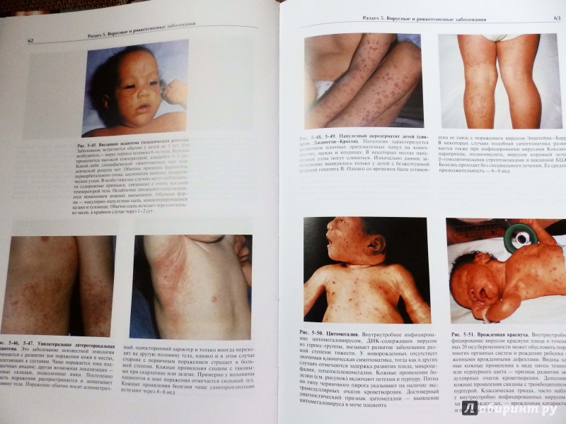 Иллюстрация 16 из 18 для Детская дерматология. Атлас - Вейнберг, Проуз, Кристал | Лабиринт - книги. Источник: Бурыкина  Анастасия
