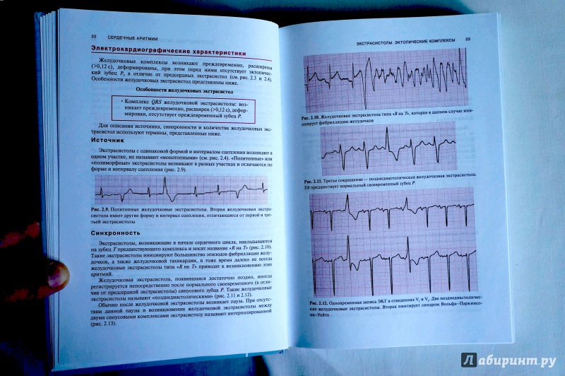 Иллюстрация 4 из 7 для Сердечные аритмии. Практические рекомендации по интерпретации кардиограмм и лечению - Дэвид Беннет | Лабиринт - книги. Источник: sakedas