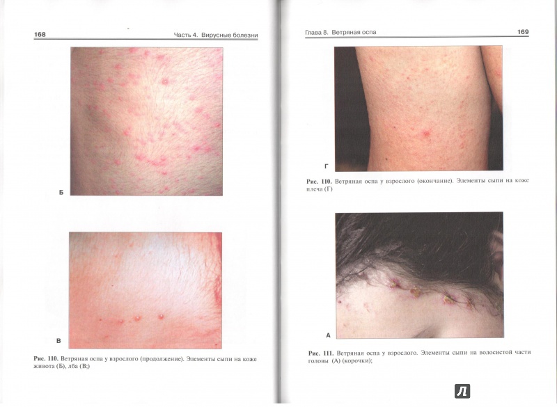 Иллюстрация 7 из 9 для Атлас инфекционных болезней - Лучшев, Жаров, Никифоров | Лабиринт - книги. Источник: ВраЧиталла