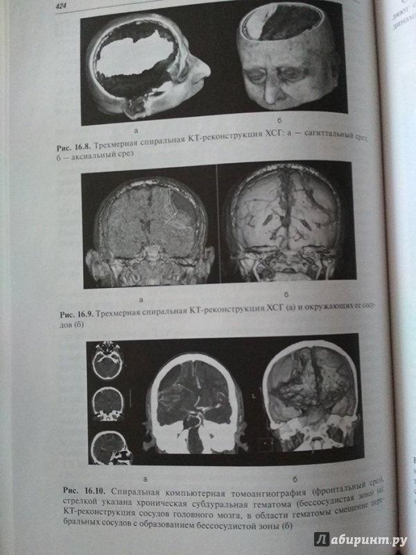 Иллюстрация 2 из 32 для Черепно-мозговая травма. Диагностика и лечение - Леонид Лихтерман | Лабиринт - книги. Источник: Кsena