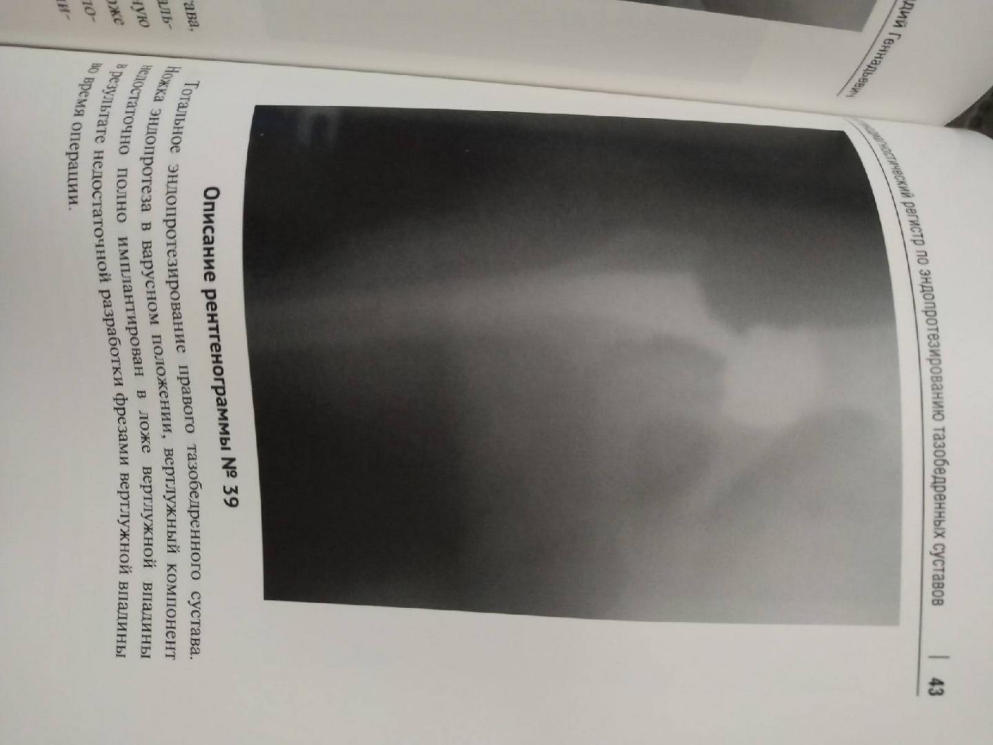 Иллюстрация 4 из 7 для Рентгенологический регистр по эндопротезированию тазобедренных суставов - Геннадий Батыгин | Лабиринт - книги. Источник: Doc_radiology