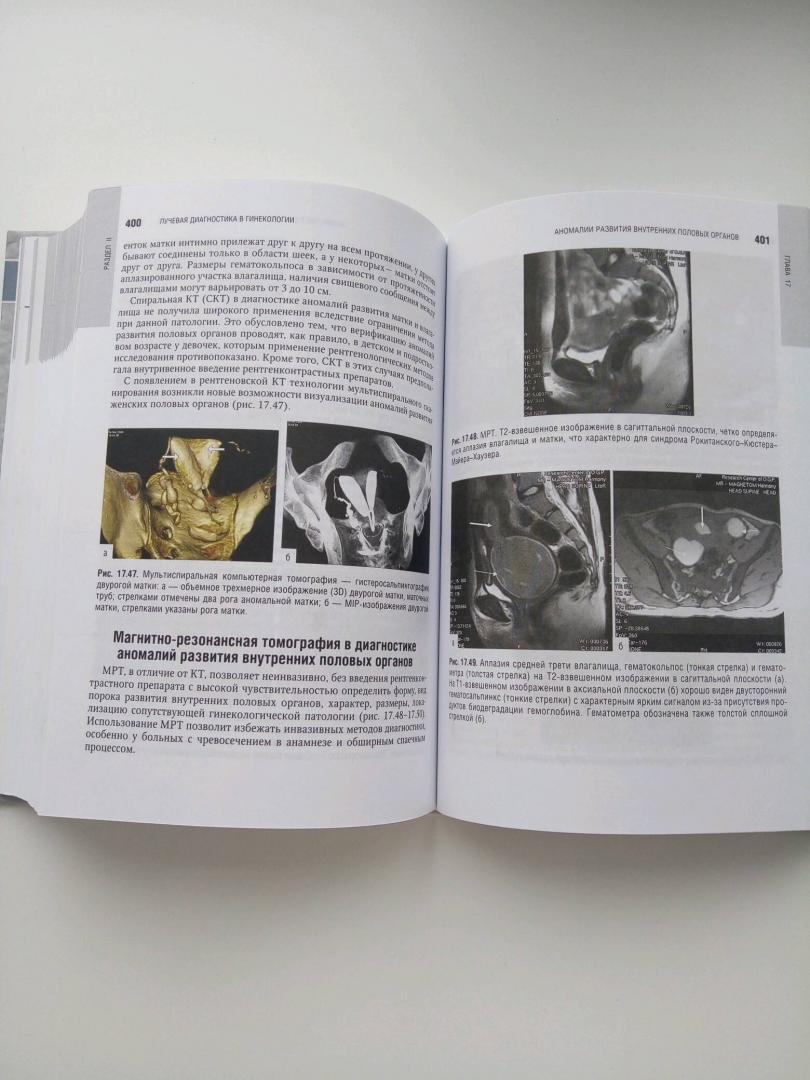 Иллюстрация 26 из 29 для Лучевая диагностика и терапия в акушерстве и гинекологии - Адамян, Гус, Демидов, Обельчак | Лабиринт - книги. Источник: Лабиринт