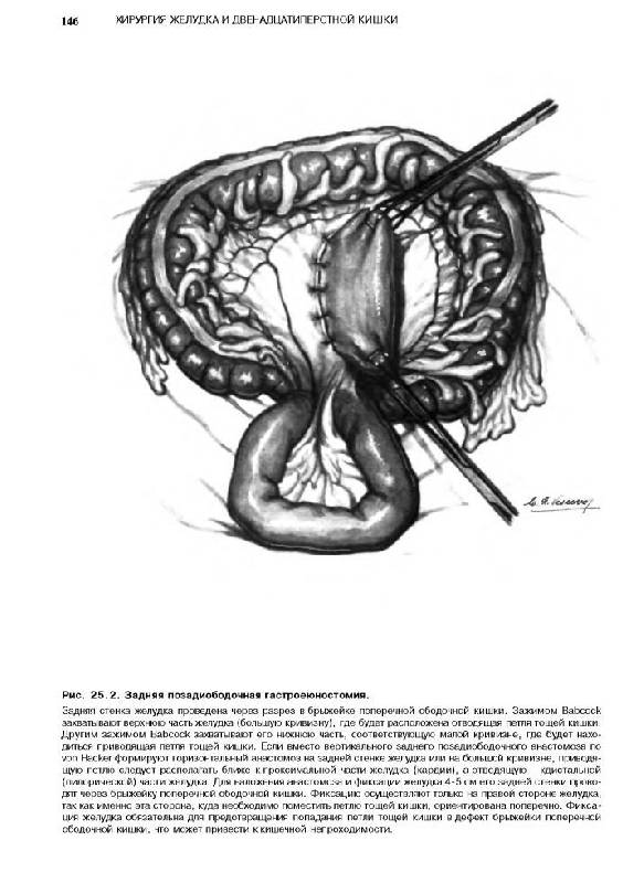 Иллюстрация 6 из 35 для Атлас абдоминальной хирургии: Том 2. Хирургия желудка и двенадцатиперстной кишки - Эмилио Итала | Лабиринт - книги. Источник: Юта