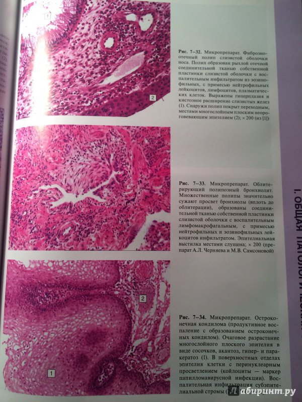 Иллюстрация 28 из 34 для Патологическая анатомия. Атлас. Учебное пособие - Зайратьянц, Бойкова, Зотова | Лабиринт - книги. Источник: | favouritevampire |