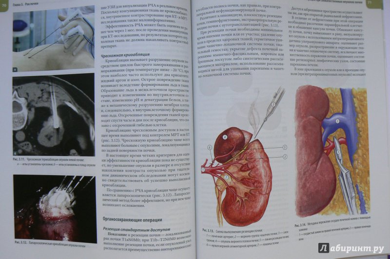 Иллюстрация 5 из 6 для Атлас операций при злокачественных опухолях органов мочеполовой системы - Каприн, Русаков, Алексеев | Лабиринт - книги. Источник: Марина