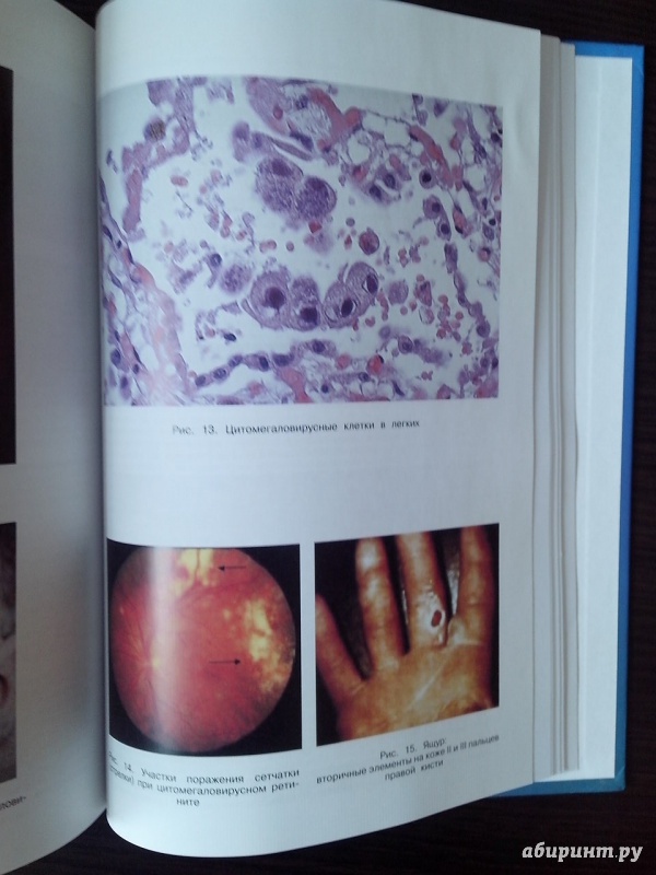 Иллюстрация 8 из 31 для Вирусные болезни человека - Лобзин, Белозеров, Беляева | Лабиринт - книги. Источник: Kukula
