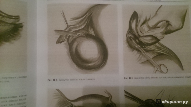 Иллюстрация 3 из 8 для Оперативная гинекология. Атлас - Хирш, Кезер, Икле | Лабиринт - книги. Источник: uluchez