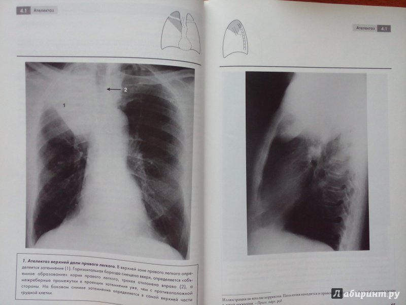 Иллюстрация 7 из 11 для Рентгенография грудной клетки - Корн, Пойнтон | Лабиринт - книги. Источник: Савостин  Александр