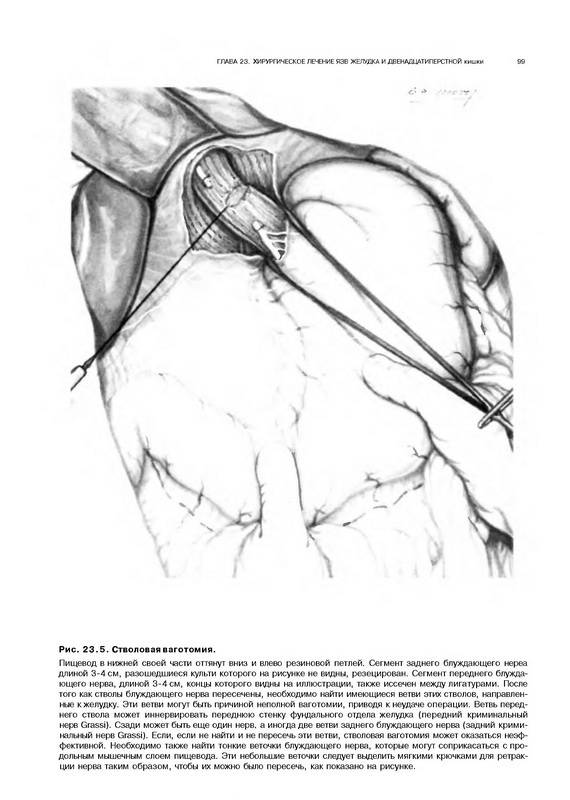 Иллюстрация 16 из 35 для Атлас абдоминальной хирургии: Том 2. Хирургия желудка и двенадцатиперстной кишки - Эмилио Итала | Лабиринт - книги. Источник: Риззи