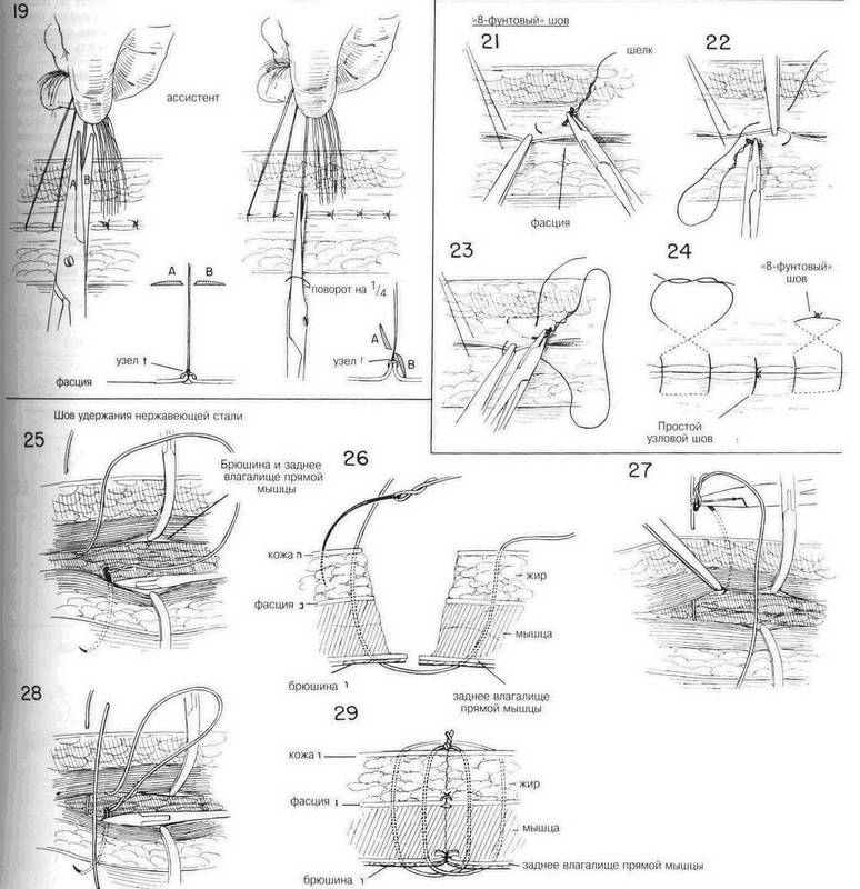 Иллюстрация 17 из 19 для Атлас хирургических операций - Золлингер, Золлингер | Лабиринт - книги. Источник: Ялина
