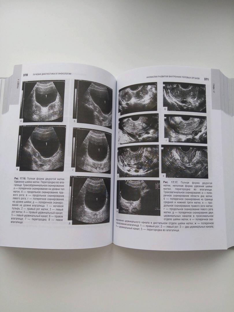Иллюстрация 25 из 29 для Лучевая диагностика и терапия в акушерстве и гинекологии - Адамян, Гус, Демидов, Обельчак | Лабиринт - книги. Источник: Лабиринт