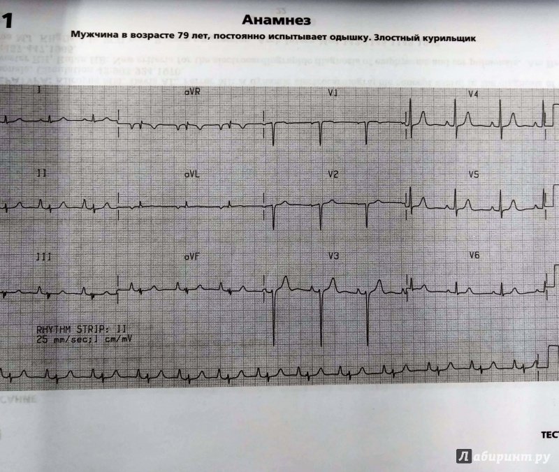 Иллюстрация 19 из 20 для Клиническая электрокардиография - Франклин Циммерман | Лабиринт - книги. Источник: Савчук Ирина