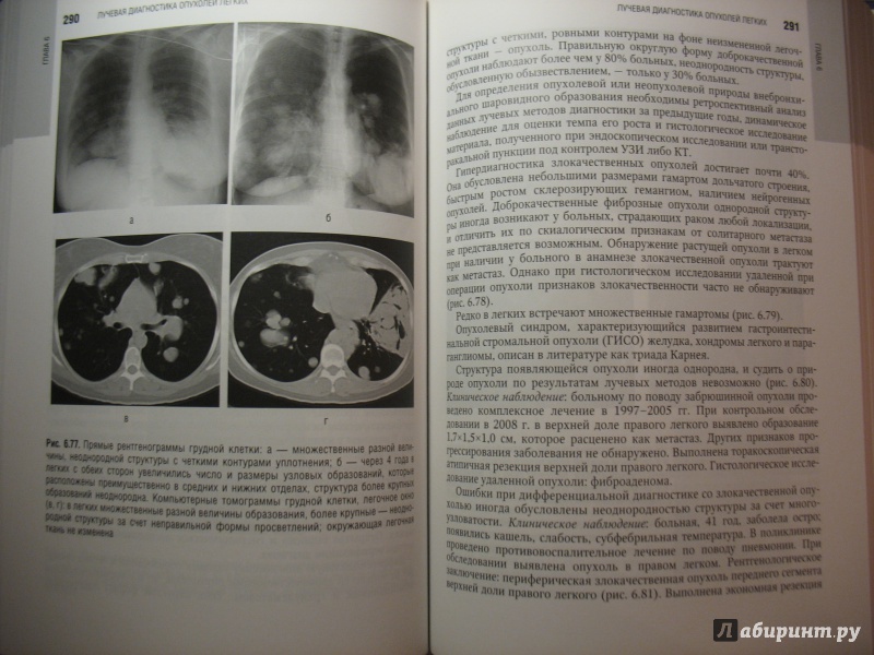 Иллюстрация 8 из 10 для Лучевая диагностика органов грудной клетки. Национальное руководство - Троян, Шехтер, Алексеева | Лабиринт - книги. Источник: Крелена