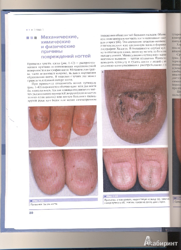 Иллюстрация 6 из 7 для Дифференциальная диагностика поражений ногтей. Атлас - Бэран, Ханеке | Лабиринт - книги. Источник: Волкова  Светлана