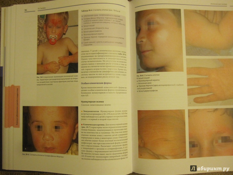 Иллюстрация 9 из 10 для Детская дерматология - Петер Хегер | Лабиринт - книги. Источник: Юлия