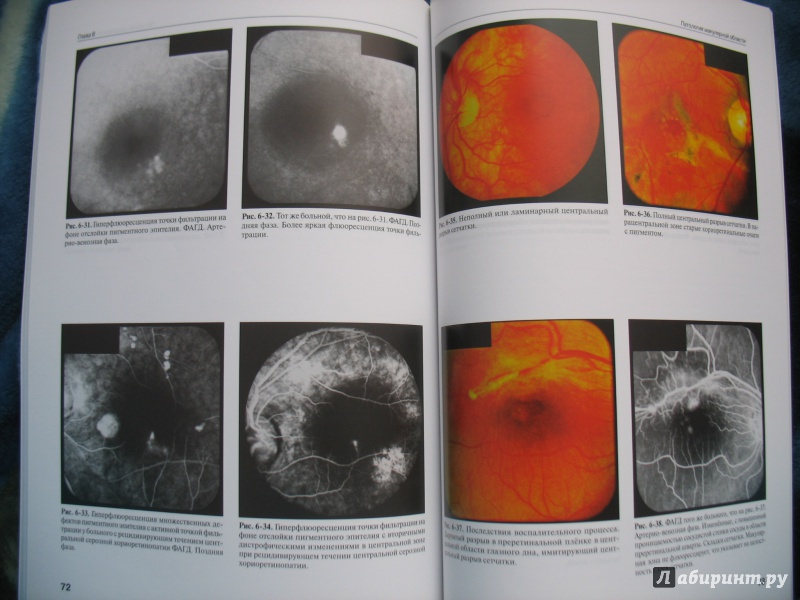 Иллюстрация 6 из 10 для Клинический атлас патологии глазного дна - Кацнельсон, Лысенко, Балишанская | Лабиринт - книги. Источник: Крелена