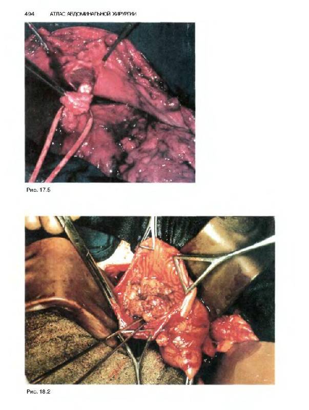 Иллюстрация 11 из 44 для Атлас абдоминальной хирургии. Том 1. Хирургия печени, желчных путей, поджелудочной железы - Эмилио Итала | Лабиринт - книги. Источник: Юта