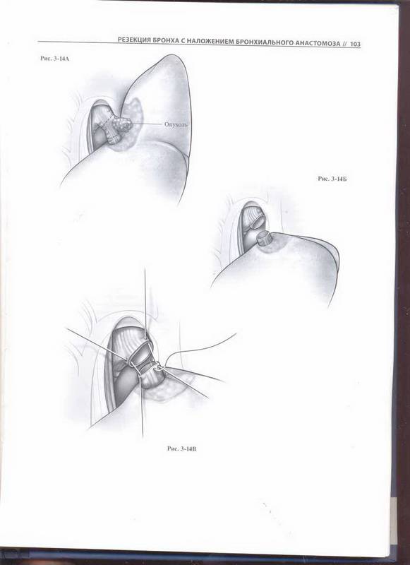 Иллюстрация 11 из 30 для Атлас торакальной хирургии - Марк Фергюсон | Лабиринт - книги. Источник: Ялина