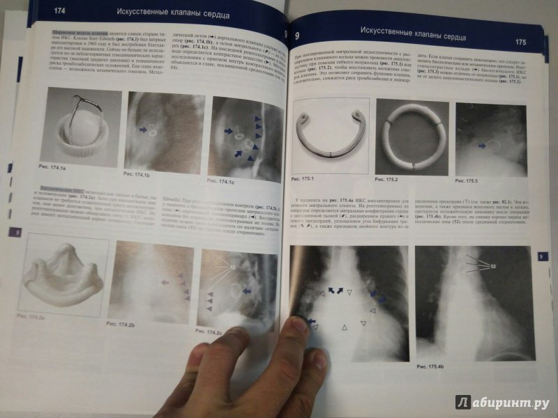 Иллюстрация 5 из 32 для Рентгенологическое исследование грудной клетки. Практическое руководство - Матиас Хофер | Лабиринт - книги. Источник: Лабиринт