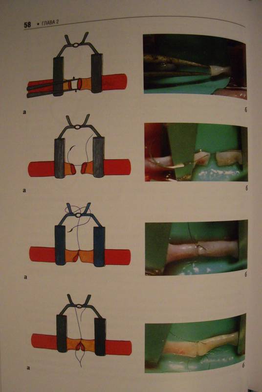 Иллюстрация 12 из 13 для Основы микрохирургии - Геворков, Мартиросян, Дыдыкин, Элиава | Лабиринт - книги. Источник: Ялина