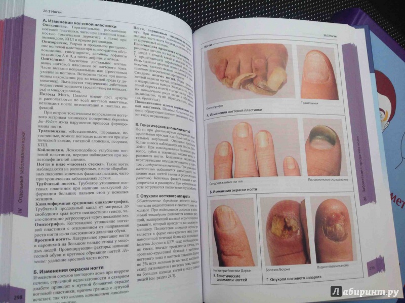 Иллюстрация 12 из 14 для Атлас по дерматологии - Бургдорф, Рекен, Шаллер, Заттлер | Лабиринт - книги. Источник: ВраЧиталла